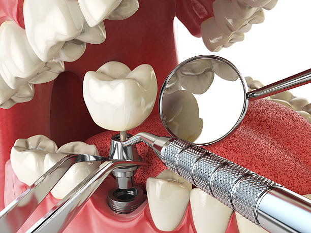 Best Emergency Root Canal Treatment in Powell, OH